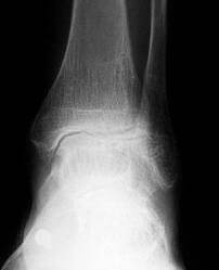 Arthritic Ankle Ankle arthritis treatment in the Issaquah, WA 98027 area