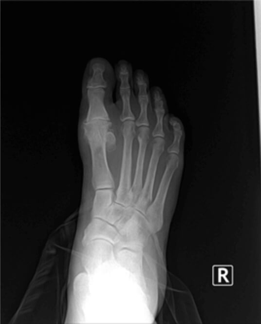 Dr. Timothy Young discusses the Adductoplasty Procedure for Midfoot Arthritis: A Comprehensive Guide