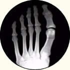 Dr. Brandon Nelson, A Double Board Certified Foot Physician & Surgeon, Issaquah’s Top Podiatrist, Discusses Bunion Surgery