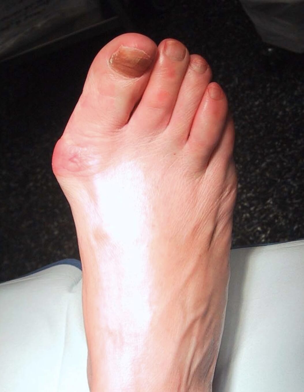 Dr. Timothy Young, a Board-Certified Foot Surgeon Discusses: Potential Risks Associated With Bunion Surgery.
