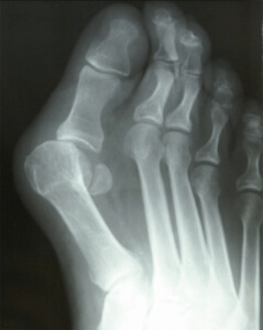Dr Brandon Nelson, A Double Board-Certified Physician & Surgeon, Discusses Patients Decide to Have Bunion Surgery