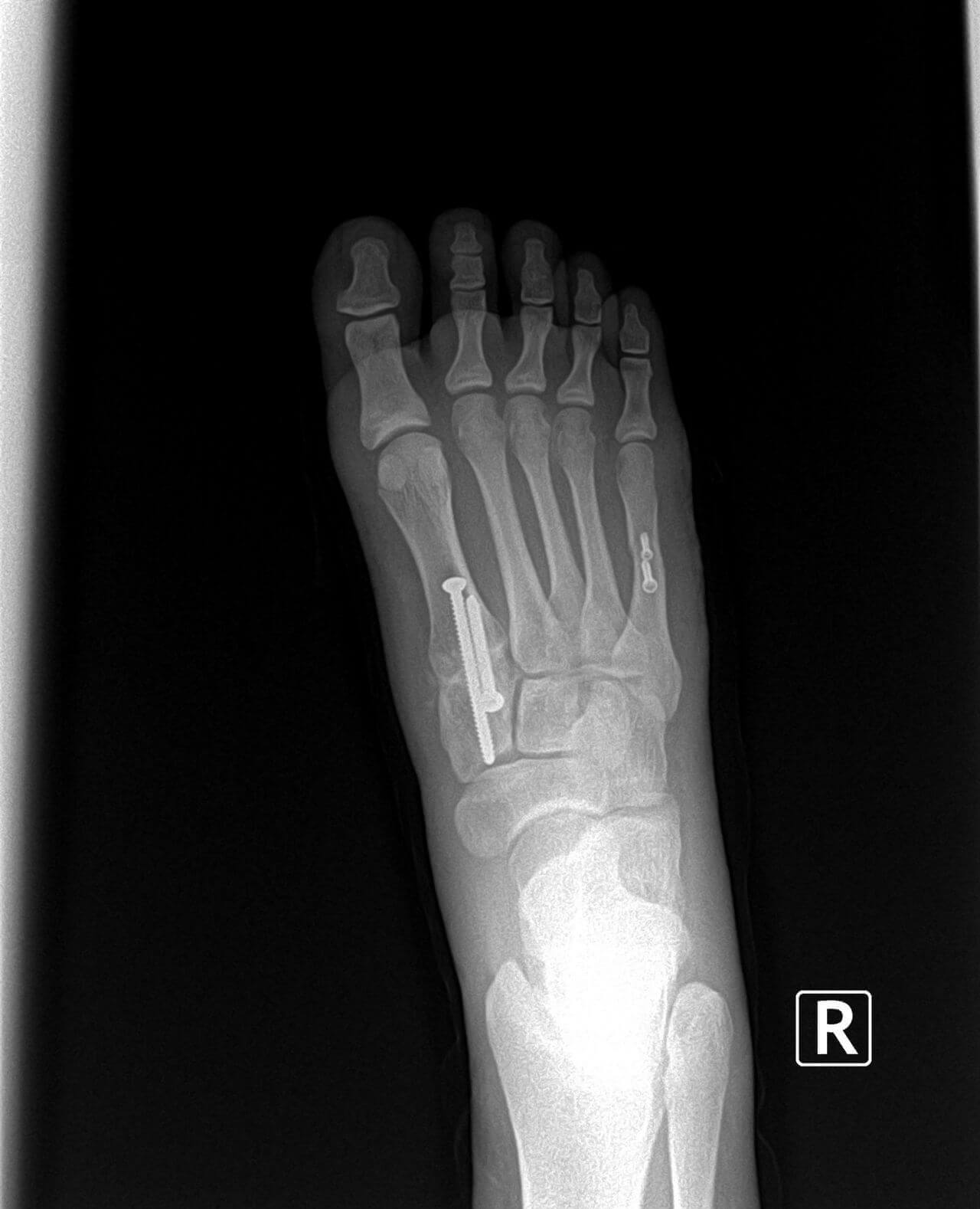 This represents part 2 of the Bunion and Tailor's bunion surgery