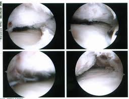Ankle Arthroscopy Ankle Arthroscopy in the Issaquah, WA 98027 area