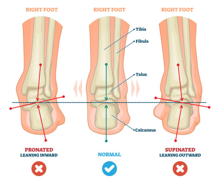 gait analysis