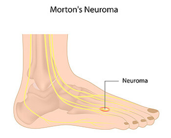 Mortons Neuroma